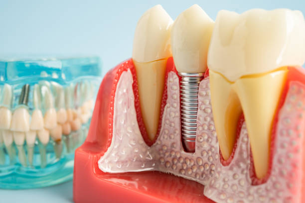 Best Dental Fillings (Composite and Amalgam)  in Moreauville, LA